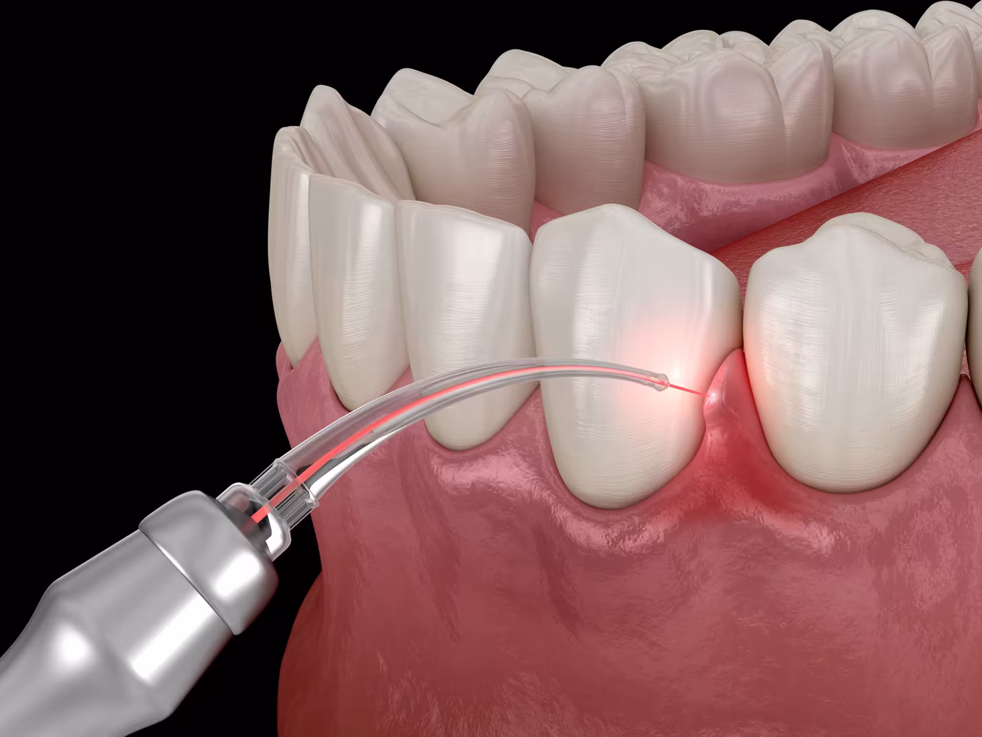 laser-gum-treatment-front